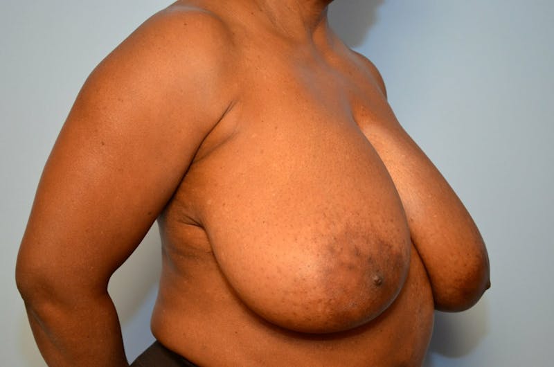 Breast Reduction Before & After Gallery - Patient 397284 - Image 3