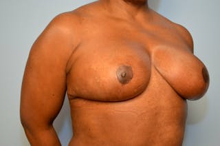 Breast Reduction Before & After Gallery - Patient 397284 - Image 4