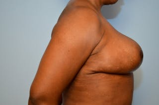 Breast Reduction Before & After Gallery - Patient 397284 - Image 6