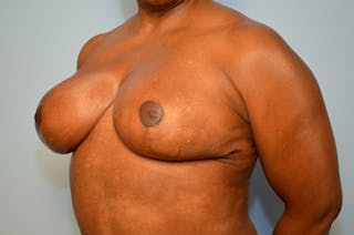 Breast Reduction Before & After Gallery - Patient 397284 - Image 8