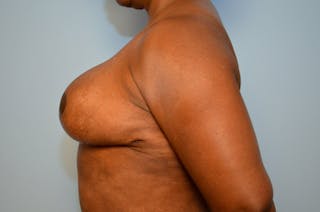 Breast Reduction Before & After Gallery - Patient 397284 - Image 10