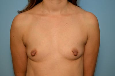 Breast Other Before & After Gallery - Patient 693010 - Image 1