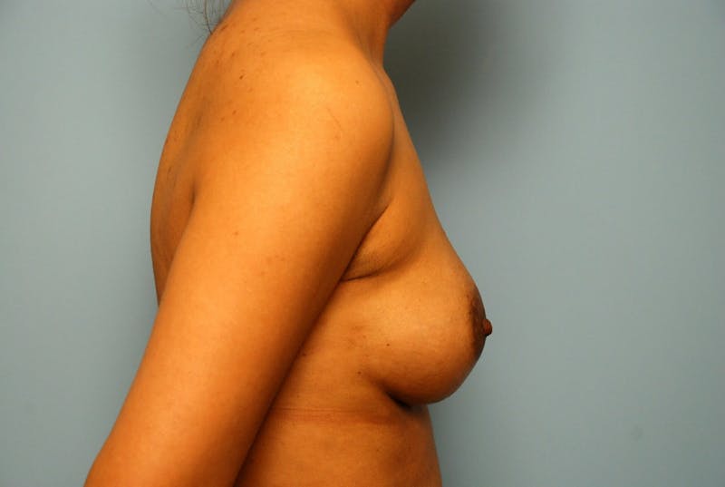 Breast Implant Exchange Before & After Gallery - Patient 131830 - Image 5