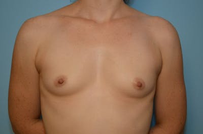 Breast Other Before & After Gallery - Patient 656961 - Image 1