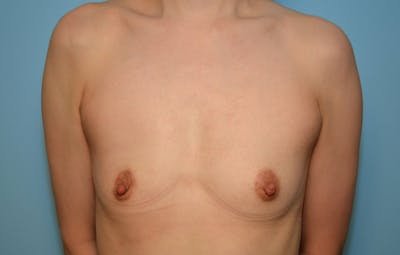Breast Other Before & After Gallery - Patient 380362 - Image 1
