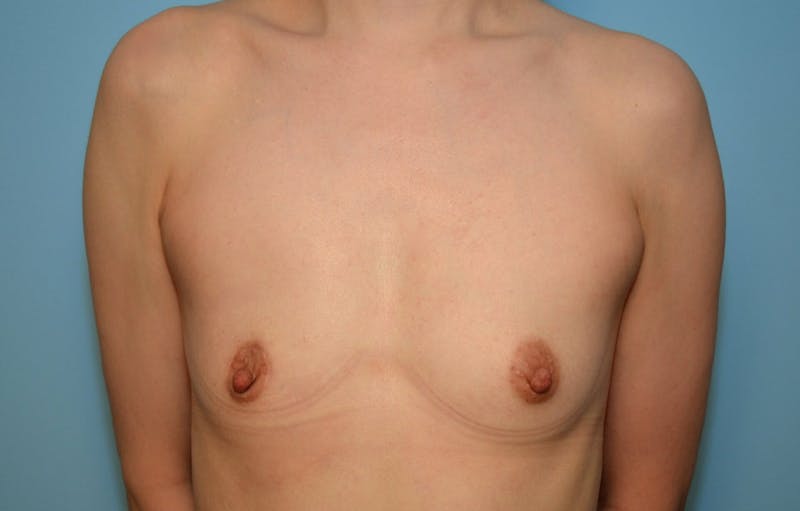 Breast Other Before & After Gallery - Patient 380362 - Image 1