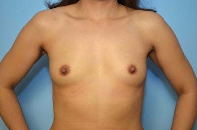 Breast Other Before & After Gallery - Patient 365209 - Image 1