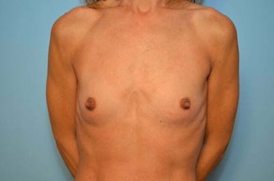 Breast Other Before & After Gallery - Patient 351290 - Image 1