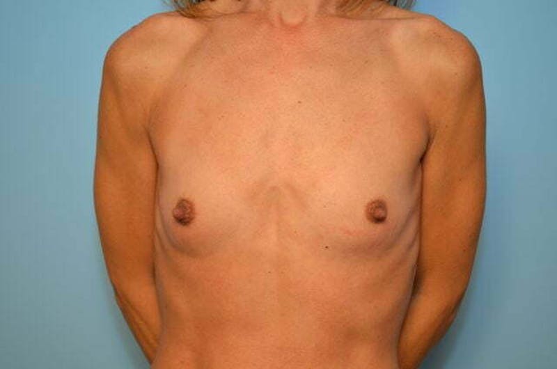 Breast Other Before & After Gallery - Patient 351290 - Image 1