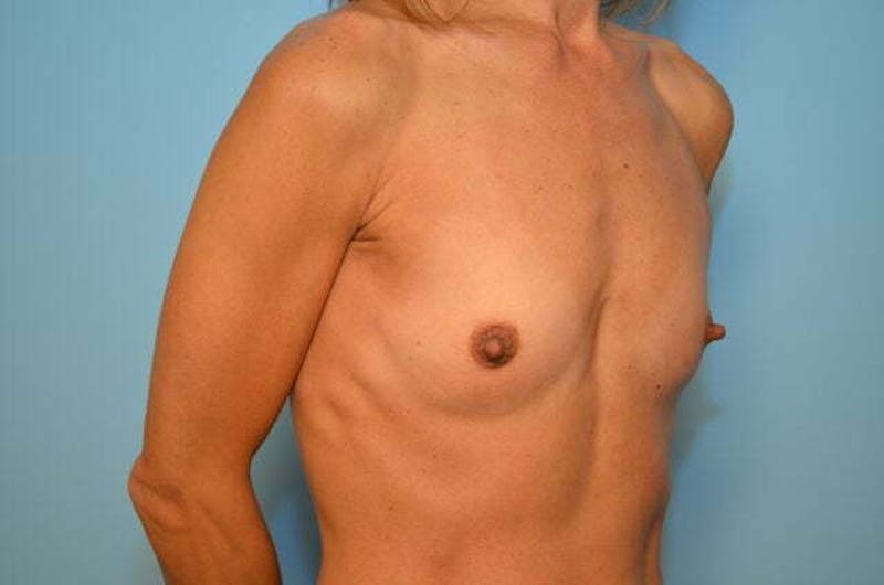 Breast Other Before & After Gallery - Patient 351290 - Image 3