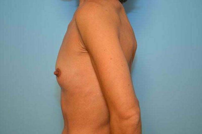 Breast Other Before & After Gallery - Patient 351290 - Image 9
