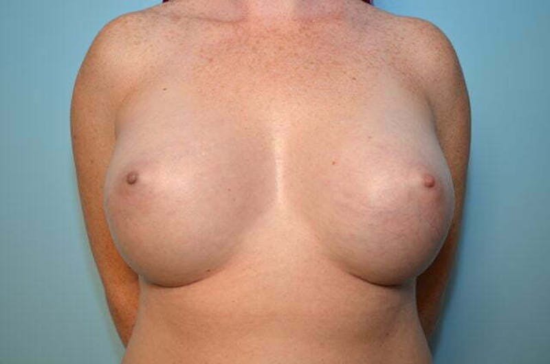 Breast Other Before & After Gallery - Patient 157530 - Image 2