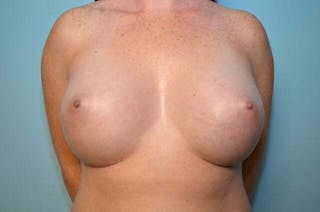 Breast Other Before & After Gallery - Patient 157530 - Image 2