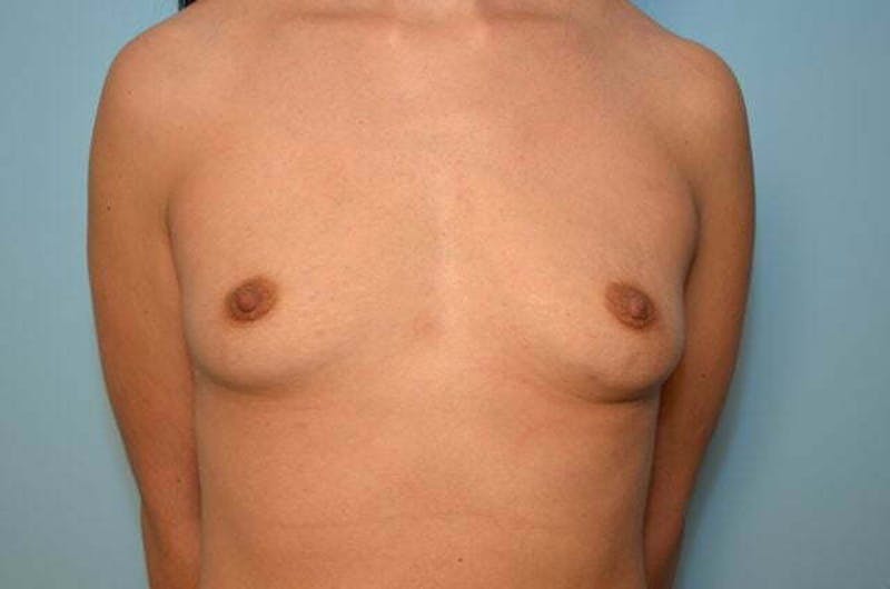 Breast Augmentation Before & After Gallery - Patient 360635 - Image 1