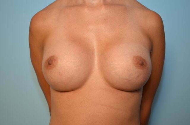 Breast Augmentation Before & After Gallery - Patient 360635 - Image 2