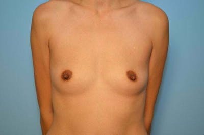 Breast Other Before & After Gallery - Patient 206537 - Image 1