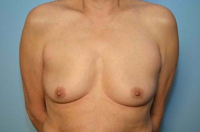 Breast Other Before & After Gallery - Patient 222142 - Image 1