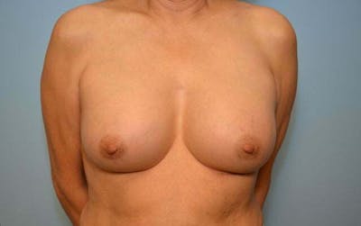 Breast Other Before & After Gallery - Patient 222142 - Image 2