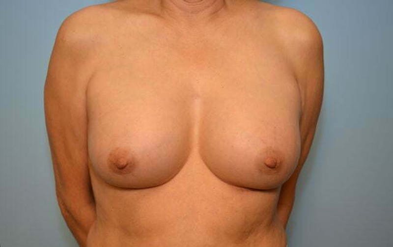 Breast Other Before & After Gallery - Patient 222142 - Image 2