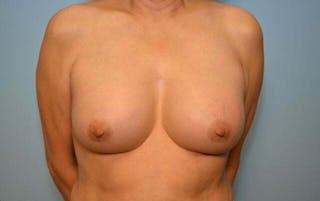 Breast Augmentation Before & After Gallery - Patient 373287 - Image 2
