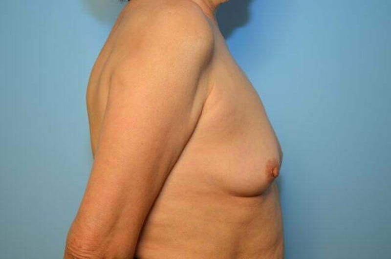 Breast Other Before & After Gallery - Patient 222142 - Image 5