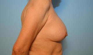 Breast Augmentation Before & After Gallery - Patient 373287 - Image 6