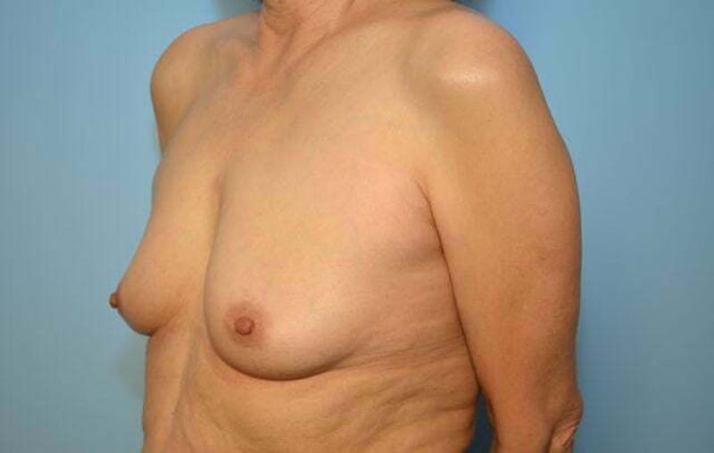 Breast Other Before & After Gallery - Patient 222142 - Image 7