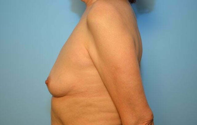 Breast Other Before & After Gallery - Patient 222142 - Image 9