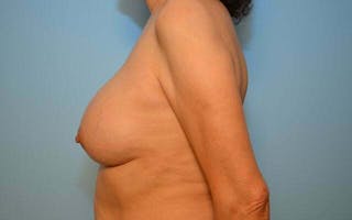Breast Augmentation Before & After Gallery - Patient 373287 - Image 10