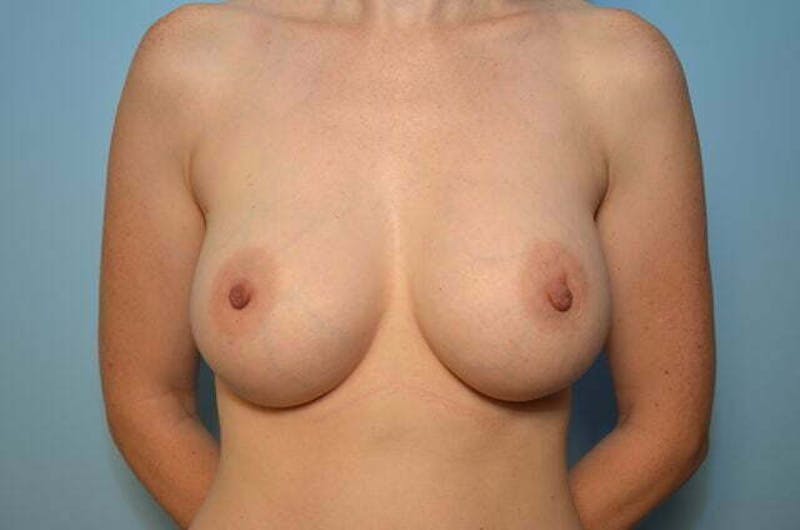 Breast Augmentation Before & After Gallery - Patient 216718 - Image 2