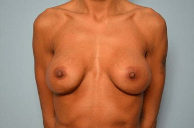 Breast Implant Exchange Before & After Gallery - Patient 605103 - Image 1