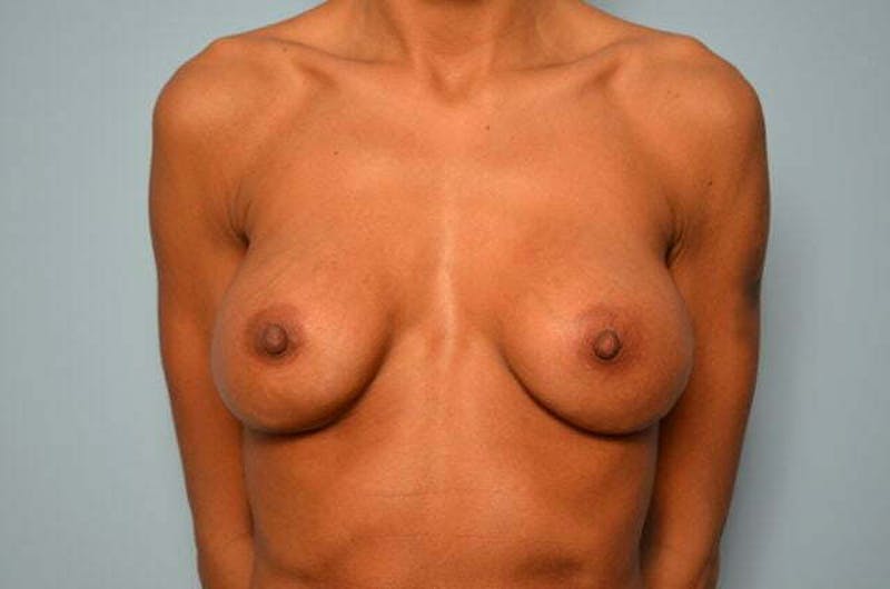 Breast Implant Exchange Before & After Gallery - Patient 605103 - Image 1