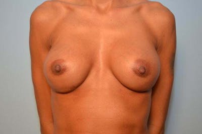 Breast Implant Exchange Before & After Gallery - Patient 605103 - Image 2