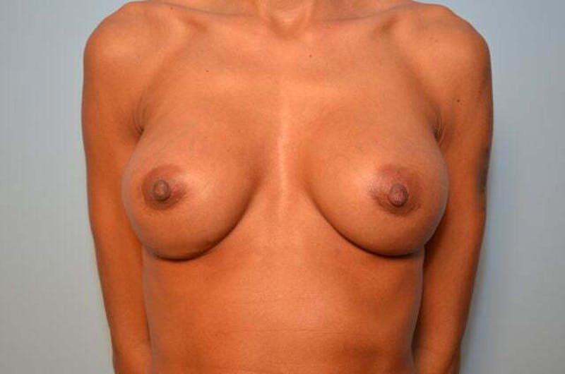 Breast Implant Exchange Before & After Gallery - Patient 605103 - Image 2