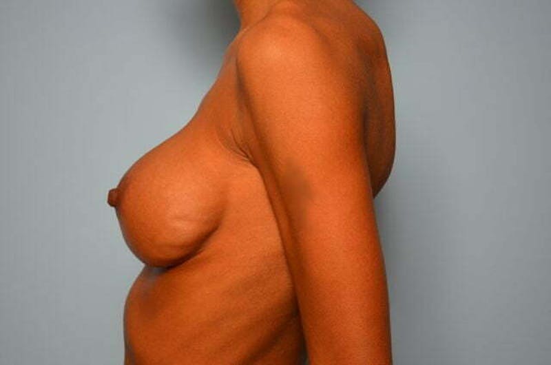 Breast Implant Exchange Before & After Gallery - Patient 605103 - Image 9