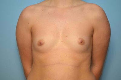 Breast Other Before & After Gallery - Patient 306433 - Image 1