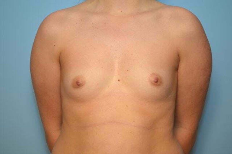 Breast Augmentation Before & After Gallery - Patient 233897 - Image 1