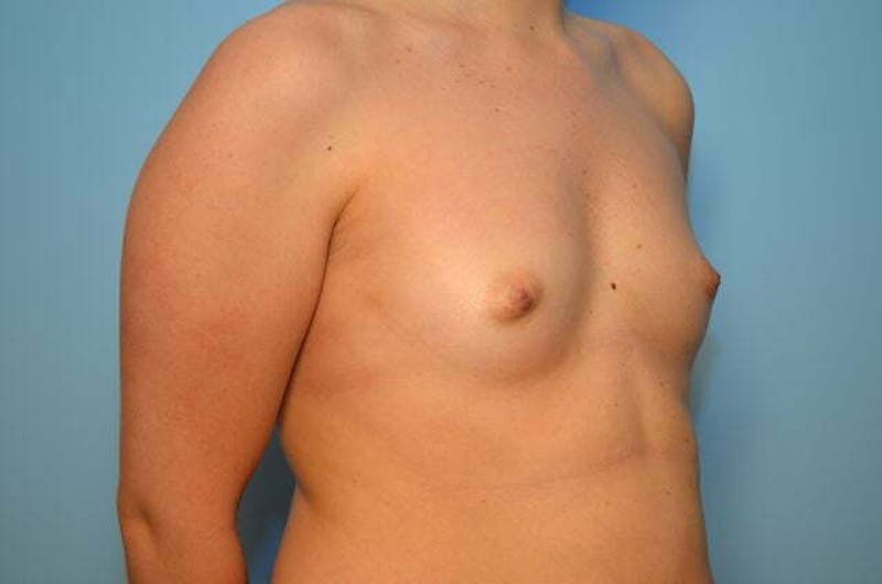 Breast Augmentation Before & After Gallery - Patient 233897 - Image 3