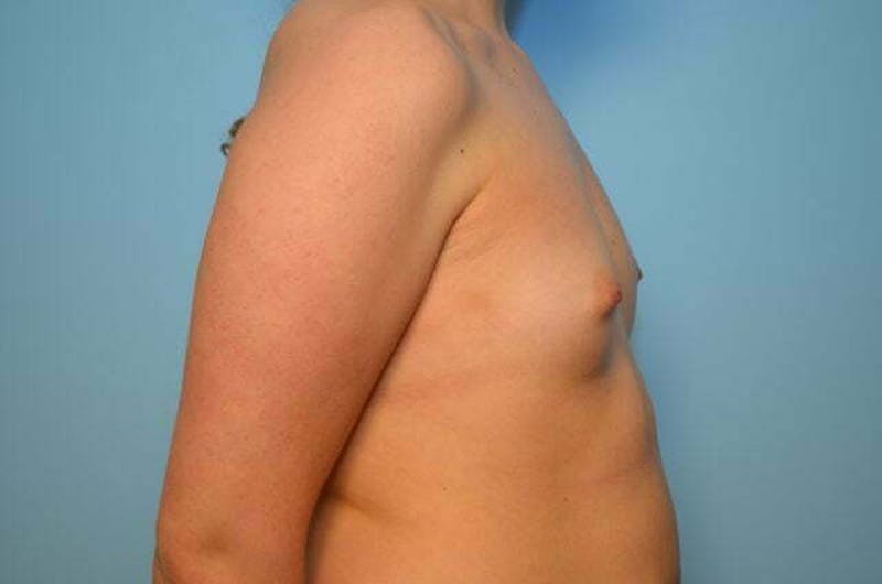 Breast Augmentation Before & After Gallery - Patient 233897 - Image 5