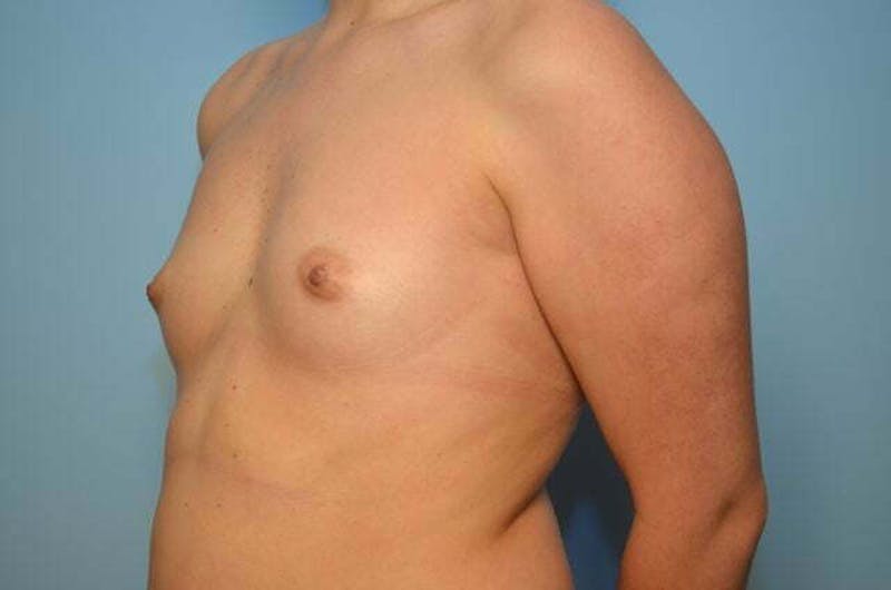 Breast Augmentation Before & After Gallery - Patient 233897 - Image 7