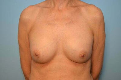Breast Implant Exchange Before & After Gallery - Patient 225459 - Image 1