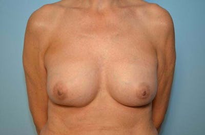 Breast Implant Exchange Before & After Gallery - Patient 225459 - Image 2