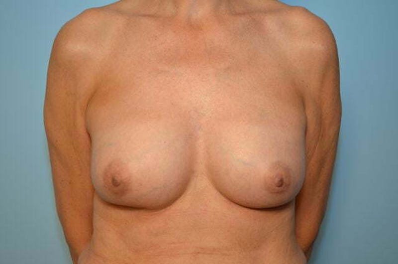 Breast Implant Exchange Before & After Gallery - Patient 225459 - Image 2