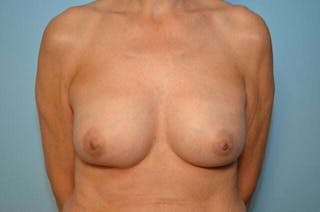 Breast Implant Removal Before & After Gallery - Patient 163259 - Image 2