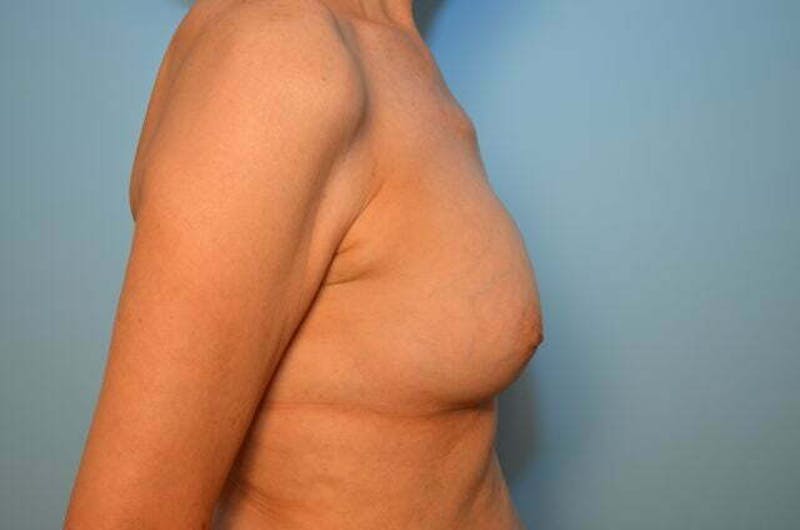 Breast Implant Exchange Before & After Gallery - Patient 225459 - Image 5
