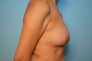 Breast Implant Removal Before & After Gallery - Patient 163259 - Image 6