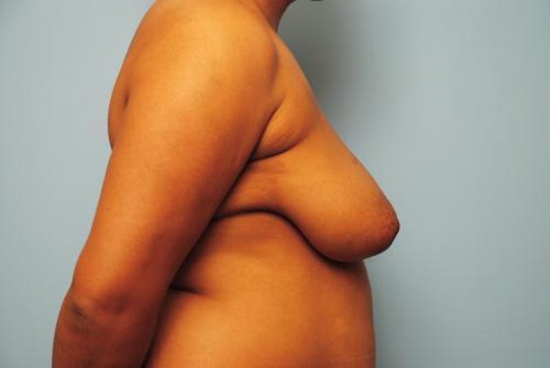 Breast Reduction Before & After Gallery - Patient 306402 - Image 5
