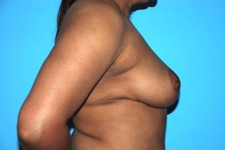 Breast Reduction Before & After Gallery - Patient 333522 - Image 6