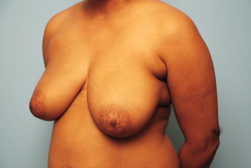 Breast Reduction Before & After Gallery - Patient 306402 - Image 7