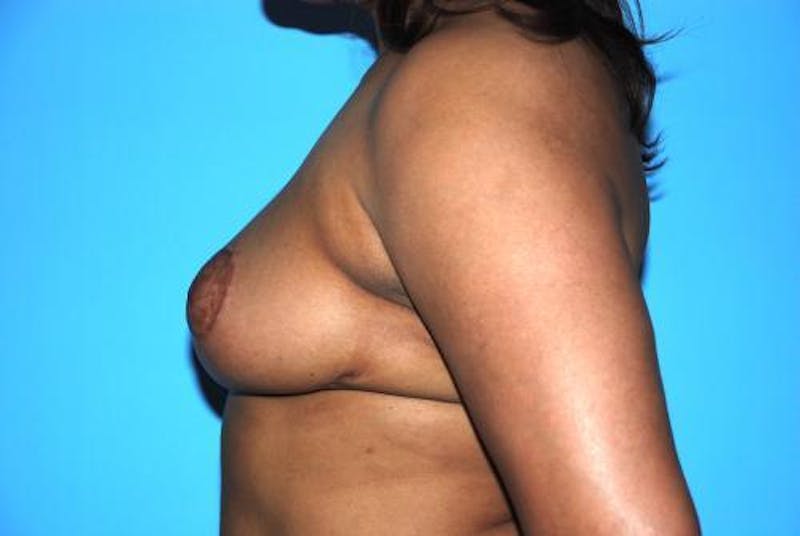 Breast Reduction Before & After Gallery - Patient 306402 - Image 10